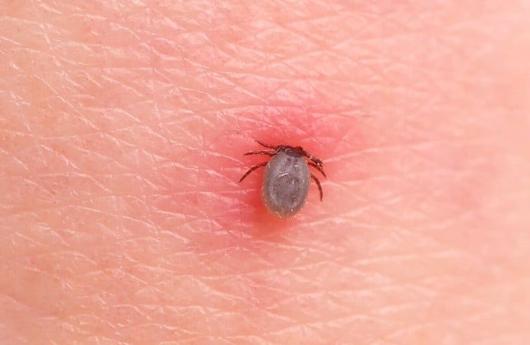 A slightly engorged tick attached to human skin.